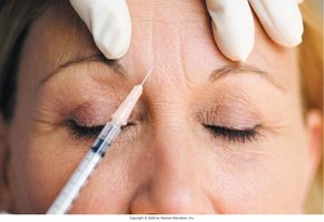 Botox injection