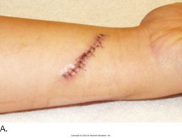 Wound closure with sutures