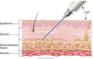 Hypodermic injection into subcutaneous tissue