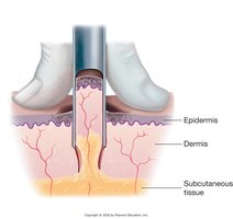 Punch biopsy