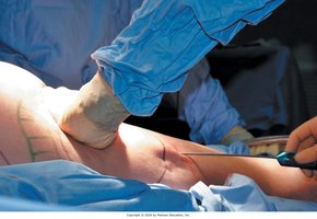 Liposuction procedure