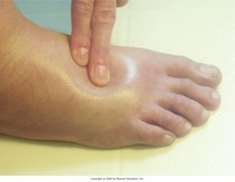 Pitting edema