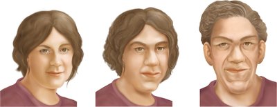 Progression of acromegaly in a woman