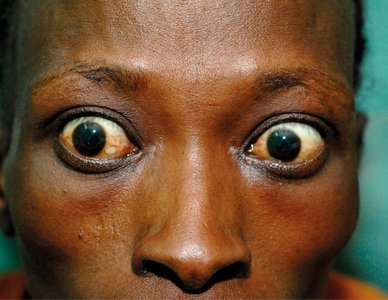 Exophthalmos in hyperthyroidism