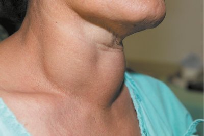 Goiter in the neck