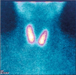 Thyroid scan image