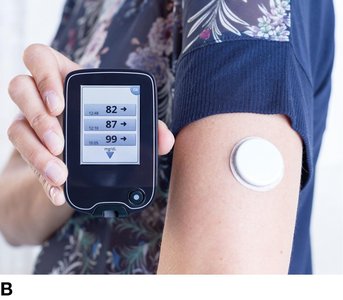 Continuous glucose monitor