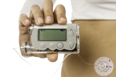 Insulin pump attached to the body