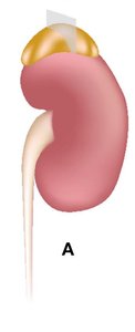 Adrenal gland above the kidney