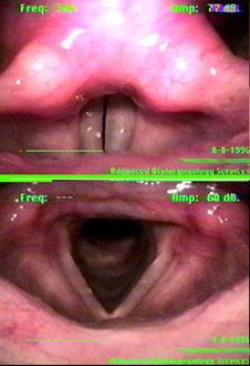 Epiglottis covering the larynx