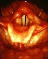 Larynx and trachea anatomy