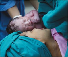 Cyanosis in newborn