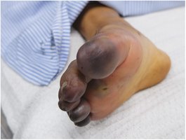 Necrosis and gangrene