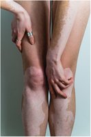 Vitiligo depigmentation