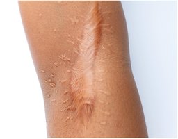 Keloid scar