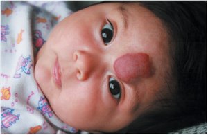 Hemangioma in infant