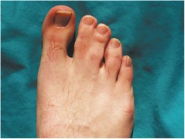 Syndactyly fused toes