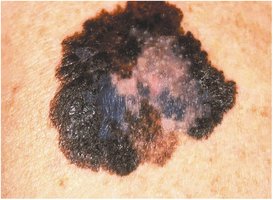 Malignant melanoma