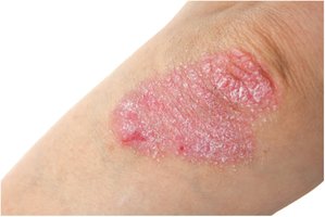 Psoriasis on elbow
