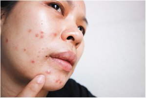 Acne vulgaris