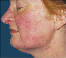 Rosacea on face
