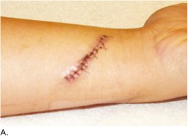 Wound closure with sutures