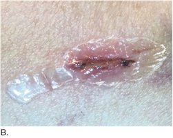 Wound closure with surgical glue