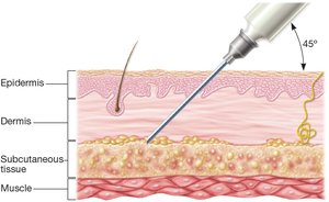 Hypodermic injection