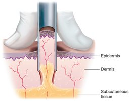 Punch biopsy
