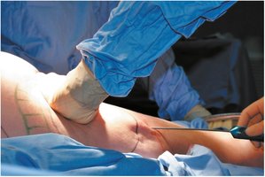 Liposuction procedure