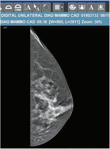 Mammogram image of the breast