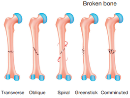 Types of bone fractures