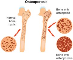 Normal bone, osteopenia, and osteoporosis comparison