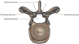 Thoracic vertebra with missing spinous process