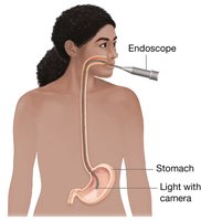 Endogastric procedure using an endoscope to observe the internal stomach lining.