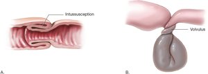 Intussusception and volvulus