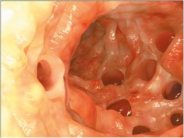 Diverticula in the colon