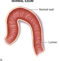 Normal ileum
