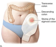 Colostomy and stoma