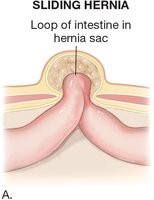 Sliding hernia