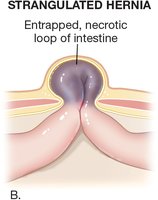 Strangulated hernia