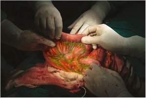 Peritonitis during surgery