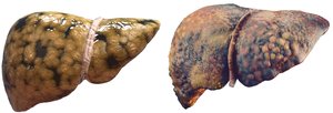 Fatty liver and cirrhosis