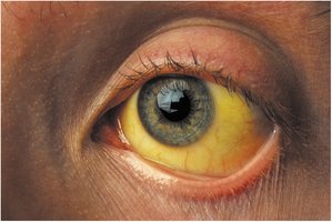 Jaundice (scleral icterus)