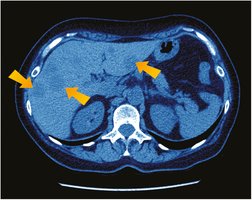 Liver cancer on CT scan