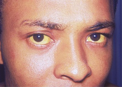 Jaundice, yellowing of the sclera and skin
