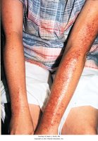 Photodermatitis