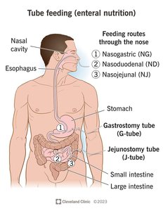 Tube feeding routes