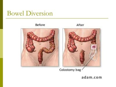 Colostomy types