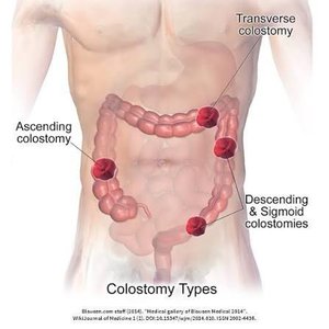 Comparison of colostomies and ileostomy